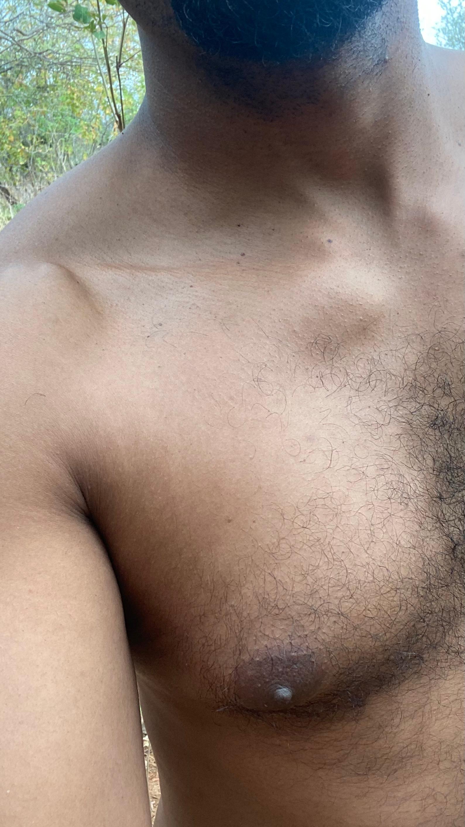 negrodovitiligo Live Image